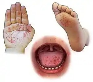 Narraville Primary Confirms Hand Foot and Mouth Disease Cases 2
