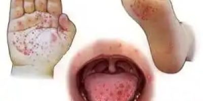 Narraville Primary Confirms Hand, Foot and Mouth Disease Cases