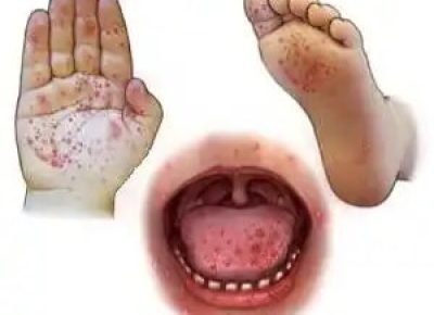 Narraville Primary Confirms Hand, Foot and Mouth Disease Cases