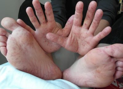 Government Clarifies Difference Between FMD and HFMD