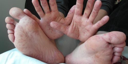 Government Clarifies Difference Between FMD and HFMD